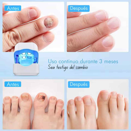 NailThera™ LED - La forma más avanzada, segura y cómoda de cuidar tus uñas y prevenir los hongos… sin salir de casa.